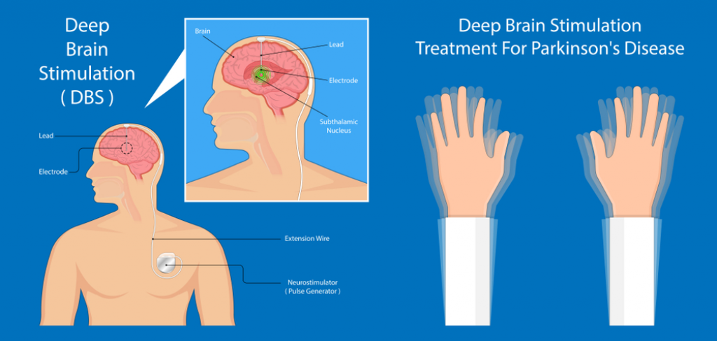 Deep brain. DBS стимулятор Паркинсона. Болезнь Паркинсона электроды в мозг.