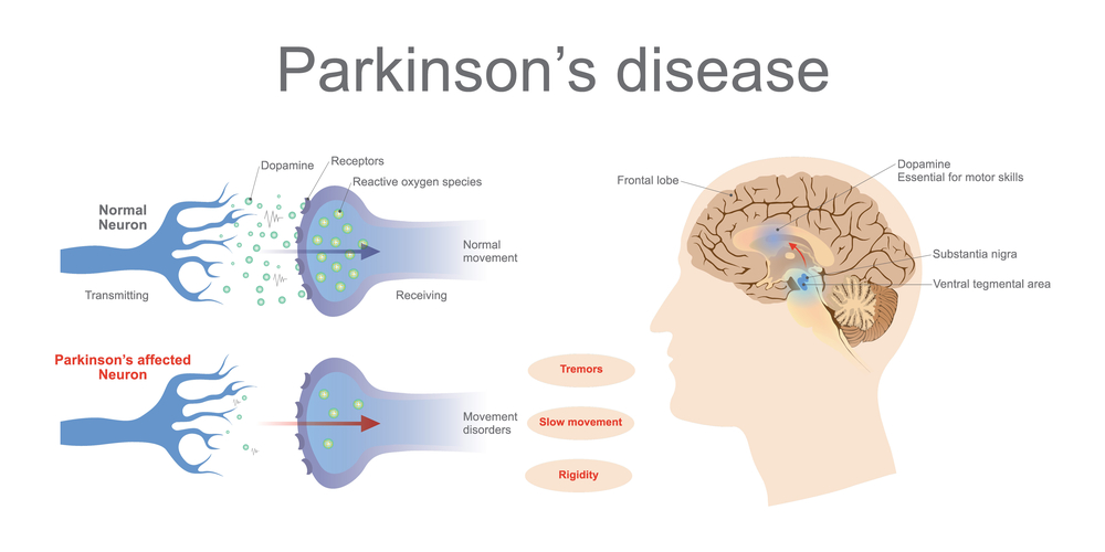 comparison of normal brain and parkinson's brain