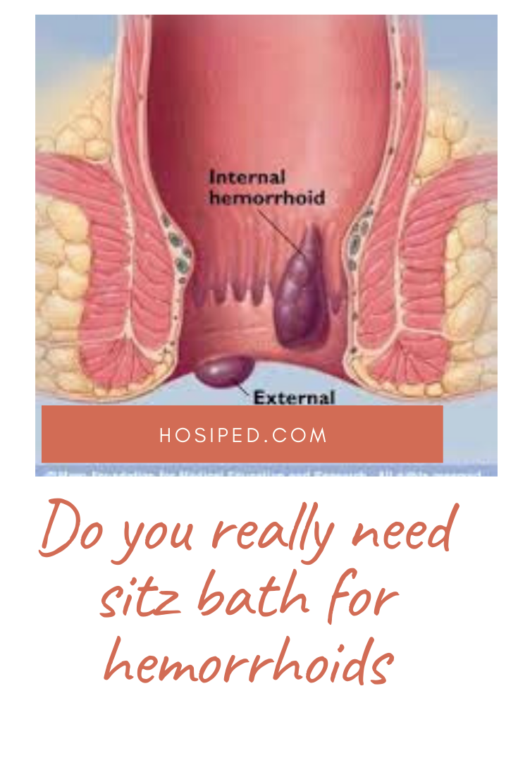 faqs about sitz baths for hemorrhoids